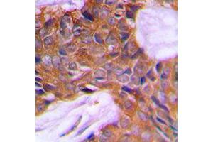 Immunohistochemical analysis of PAGE3 staining in human prostate cancer formalin fixed paraffin embedded tissue section. (PAGE3 antibody  (Center))