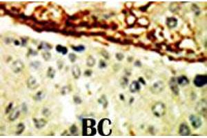 Formalin-fixed and paraffin-embedded human cancer tissue reacted with EPHA4 polyclonal antibody  , which was peroxidase-conjugated to the secondary antibody, followed by DAB staining. (EPH Receptor A4 antibody  (AA 40-70))