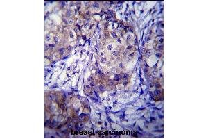 CYP1A1 Antibody (Center) (ABIN392527 and ABIN2842082) immunohistochemistry analysis in formalin fixed and paraffin embedded human breast carcinoma followed by peroxidase conjugation of the secondary antibody and DAB staining. (CYP1A1 antibody  (AA 252-280))