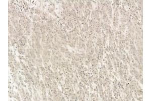 p53 Mouse Monoclonal Antibody at 1/100 staining human gastric cancer and adjacent non-tumor tissue by IHC-P. (p53 antibody  (Internal Region))