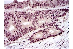 Immunohistochemical analysis of paraffin-embedded colon cancer tissues using PCNA mouse mAb with DAB staining. (PCNA antibody  (AA 53-196))