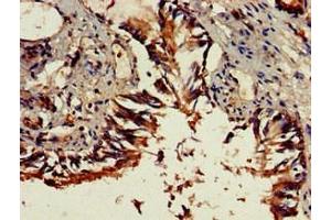 Immunohistochemistry of paraffin-embedded human lung tissue using ABIN7149671 at dilution of 1:100 (DENND1C antibody  (AA 601-801))