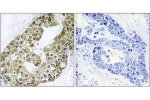 Immunohistochemistry analysis of paraffin-embedded human breast carcinoma tissue, using IkappaB-alpha (Ab-42) Antibody.