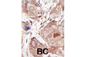 Formalin-fixed and paraffin-embedded human cancer tissue reacted with KDR polyclonal antibody  , which was peroxidase-conjugated to the secondary antibody, followed by DAB staining. (VEGFR2/CD309 antibody  (C-Term))