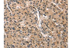 The image on the left is immunohistochemistry of paraffin-embedded Human liver cancer tissue using ABIN7190351(CRIM1 Antibody) at dilution 1/25, on the right is treated with synthetic peptide. (CRIM1 antibody)