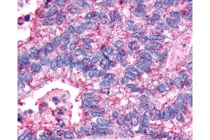 Anti-AVPR2 / V2R antibody IHC of human Colon, Carcinoma. (AVPR2 antibody  (C-Term))