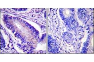 Immunohistochemistry analysis of paraffin-embedded human colon carcinoma, using eIF4B (Phospho-Ser422) Antibody. (EIF4B antibody  (pSer422))