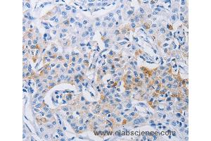 Immunohistochemistry of Human lung cancer using LRIG1 Polyclonal Antibody at dilution of 1:120