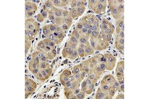 Immunohistochemical analysis of GPx-4 staining in human liver cancer formalin fixed paraffin embedded tissue section. (GPX4 antibody)