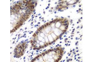 Immunohistochemistry of paraffin-embedded Human colon using MSH6 Polyclonal Antibody at dilution of 1:100 (40x lens). (MSH6 antibody)