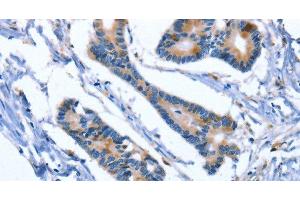 Immunohistochemistry of paraffin-embedded Human colon cancer using IBSP Polyclonal Antibody at dilution of 1:50