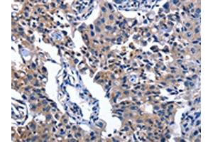 The image on the left is immunohistochemistry of paraffin-embedded Human lung cancer tissue using ABIN7130344(NAT8 Antibody) at dilution 1/50, on the right is treated with fusion protein. (NAT8 antibody)
