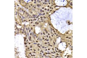 Immunohistochemistry of paraffin-embedded human oophoroma using ARID3A antibody (ABIN5975618) at dilution of 1/100 (40x lens). (ARID3A antibody)