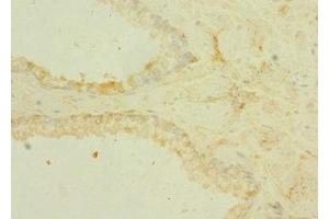 Immunohistochemistry of paraffin-embedded human prostate cancer using ABIN7172868 at dilution of 1:100 (TRPM6 antibody  (AA 740-840))