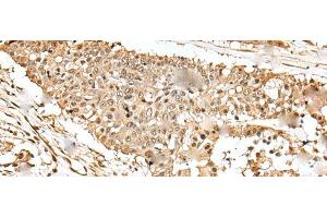Immunohistochemistry of paraffin-embedded Human colorectal cancer tissue using EEF1E1 Polyclonal Antibody at dilution of 1:35(x200) (EEF1E1 antibody)
