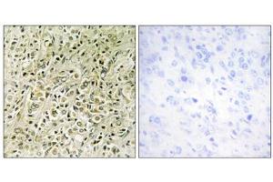 Immunohistochemistry analysis of paraffin-embedded human prostate carcinoma tissue, using RHG07 antibody. (DLC1 antibody  (N-Term))