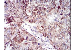 Immunohistochemical analysis of paraffin-embedded liver cancer tissues using UBE2C mouse mAb with DAB staining. (UBE2C antibody  (AA 1-179))