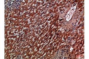 Immunohistochemical analysis of paraffin-embedded Human-liver-cancer, antibody was diluted at 1:100