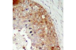 Immunohistochemical analysis of LRRC41 staining in human prostate cancer formalin fixed paraffin embedded tissue section. (LRRC41 antibody)