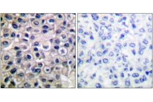 Immunohistochemistry analysis of paraffin-embedded human breast carcinoma tissue, using MMP-14 Antibody. (MMP14 antibody  (AA 471-520))