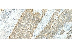 Immunohistochemistry of paraffin-embedded Human esophagus cancer tissue using ETAA1 Polyclonal Antibody at dilution of 1:25(x200) (ETAA1 antibody)