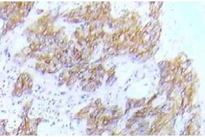 Immunohistochemistry (IHC) analyzes of p-FLT3 antibody in paraffin-embedded human lung adenocarcinoma tissue. (FLT3 antibody  (pTyr591))
