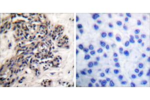 P-peptide - +Immunohistochemical analysis of paraffin-embedded human breast carcinoma tissue using HSP90B (phospho-Ser254) antibody. (HSP90AB1 antibody  (pSer254))