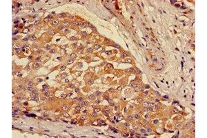 Immunohistochemistry of paraffin-embedded human breast cancer using ABIN7154002 at dilution of 1:100 (GCLM antibody  (Regulatory Subunit))