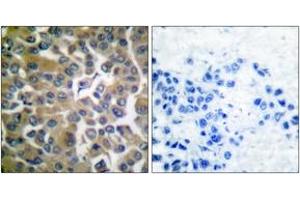 Immunohistochemistry analysis of paraffin-embedded human breast carcinoma tissue, using FAP-1 Antibody.