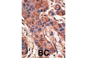 Formalin-fixed and paraffin-embedded human cancer tissue reacted with the primary antibody, which was peroxidase-conjugated to the secondary antibody, followed by AEC staining. (BMPR1A antibody  (N-Term))