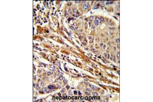 Formalin-fixed and paraffin-embedded human hepatocarcinoma reacted with APRT Antibody , which was peroxidase-conjugated to the secondary antibody, followed by DAB staining. (APRT antibody  (C-Term))