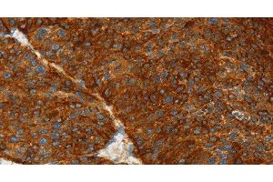 Immunohistochemistry of paraffin-embedded Human liver cancer using ASGR1 Polyclonal Antibody at dilution of 1:50 (Asialoglycoprotein Receptor 1 antibody)
