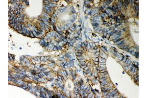 Anti- CD44 Picoband antibody, IHC(P) IHC(P): Human Intestinal Cancer Tissue