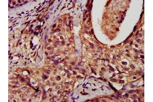 Immunohistochemistry analysis of human cervical cancer using ABIN7150829 at dilution of 1:100 (Dynamin 1-Like antibody  (AA 496-710))