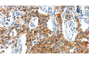 Immunohistochemistry of paraffin-embedded Human lung cancer using CKAP4 Polyclonal Antibody at dilution of 1:50 (CKAP4 antibody)