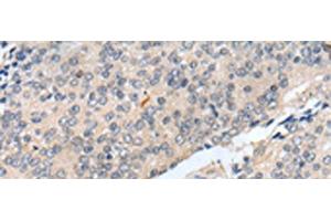 Immunohistochemistry of paraffin-embedded Human prost at e cancer tissue using MOB1B Polyclonal Antibody at dilution of 1:25(x200) (MOBKL1A antibody)
