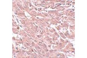 Immunohistochemistry of BCAS4 in human breast carcinoma with BCAS4 antibody at 5 μg/ml. (BCAS4 antibody  (N-Term))