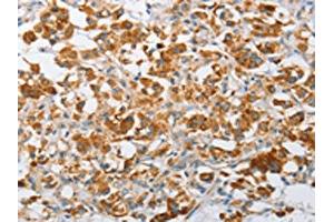 The image on the left is immunohistochemistry of paraffin-embedded Human thyroid cancer tissue using ABIN7128507(ARHGEF9 Antibody) at dilution 1/50, on the right is treated with fusion protein. (Arhgef9 antibody)