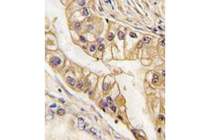 Immunohistochemical staining of formalin-fixed and paraffin-embedded human lung carcinoma tissue reacted with EPHB2 monoclonal antibody  at 1:200 dilution.