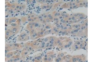 Detection of IFNa/bR1 in Human Liver cancer Tissue using Polyclonal Antibody to Interferon Alpha/Beta Receptor 1 (IFNa/bR1) (IFNAR1 antibody  (AA 28-227))