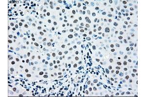 Immunohistochemical staining of paraffin-embedded Adenocarcinoma of ovary tissue using anti-MAP2K2mouse monoclonal antibody. (MEK2 antibody)