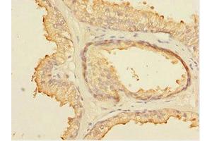 Immunohistochemistry of paraffin-embedded human prostate cancer using ABIN7152099 at dilution of 1:100 (ELF5 antibody  (AA 1-170))