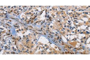 Immunohistochemistry of paraffin-embedded Human thyroid cancer using c-Fos Polyclonal Antibody at dilution of 1:70 (c-FOS antibody)