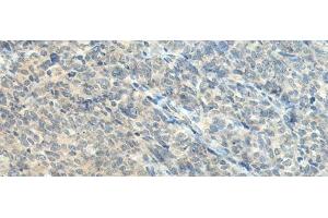 Immunohistochemistry of paraffin-embedded Human ovarian cancer tissue using CTDP1 Polyclonal Antibody at dilution of 1:55(x200) (CTDP1 antibody)