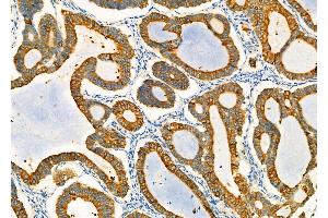 ABIN6259828 and ABIN6278001 at 1/100 staining Human ovarian cancer by IHC-P. (AGR2 antibody  (N-Term))