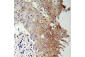 Immunohistochemical analysis of IRS1 staining in human prostate cancer formalin fixed paraffin embedded tissue section. (IRS1 antibody)