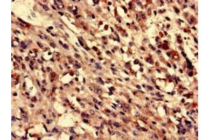 Immunohistochemistry analysis of human melanoma using ABIN7165610 at dilution of 1:100 (FUZ antibody  (AA 280-404))