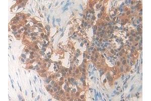 Detection of PDXK in Human Lung cancer Tissue using Polyclonal Antibody to Pyridoxal Kinase (PDXK)