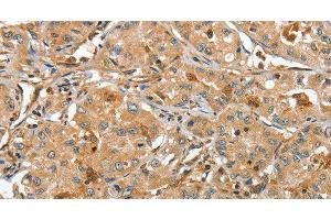 Immunohistochemistry of paraffin-embedded Human lung cancer tissue using RAP1A Polyclonal Antibody at dilution 1:45