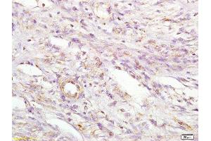 Formalin-fixed and paraffin embedded human cervical carcinoma labeled with Anti MIIP Polyclonal Antibody, Unconjugated  at 1:200 followed by conjugation to the secondary antibody and DAB staining